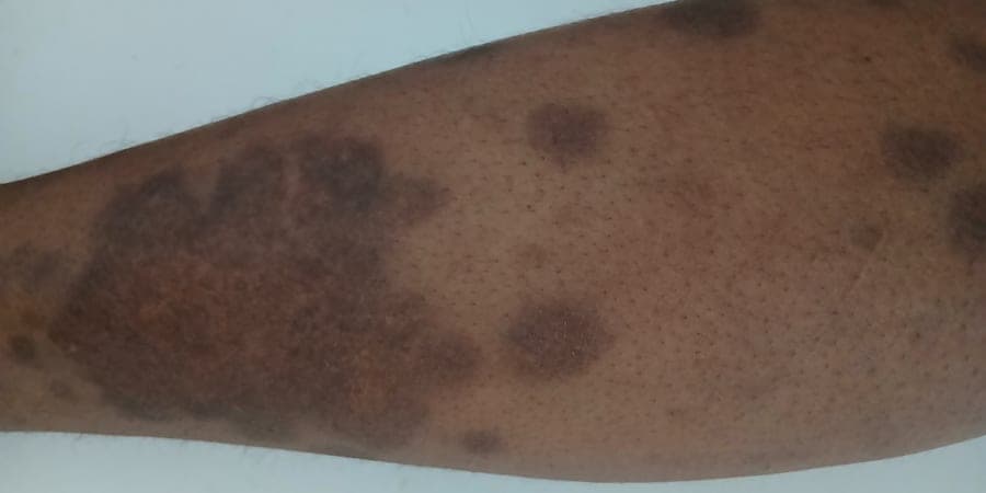 Smooth skin in soft daylight - an illustrative image for the IPL hair removal section